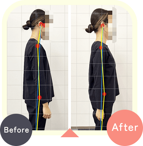 姿勢矯正ビフォーアフター