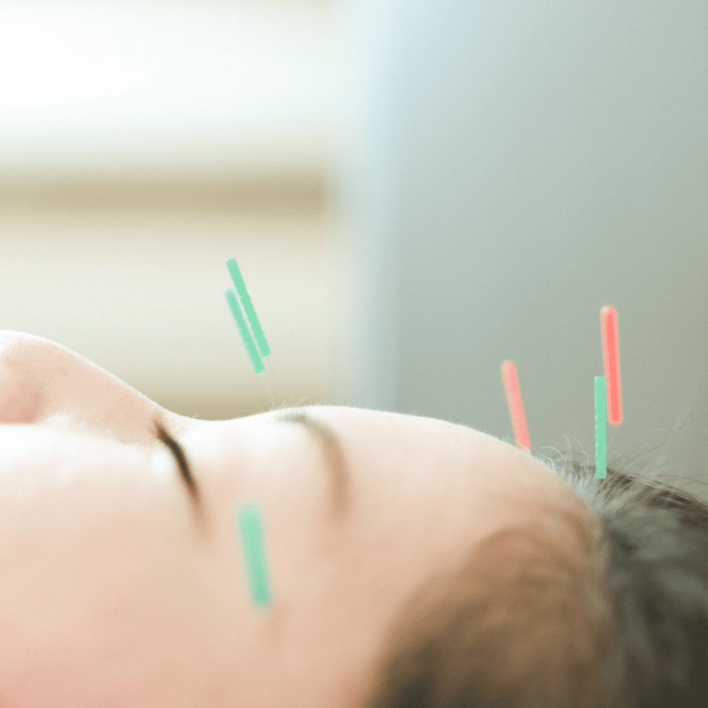 鍼灸　鍼　美容　顔