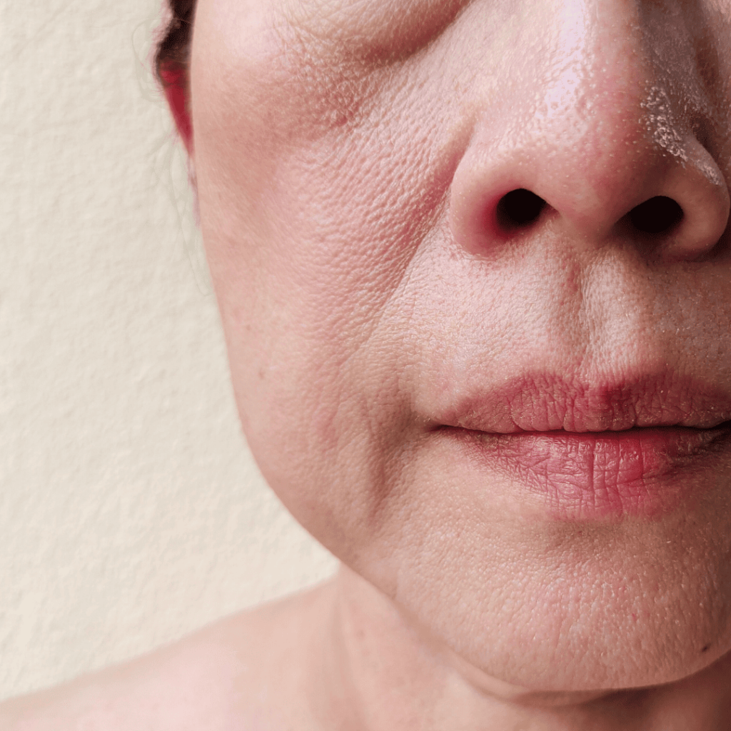 たるみ　シワ　老化