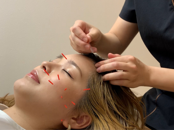 美容鍼灸　滋賀県